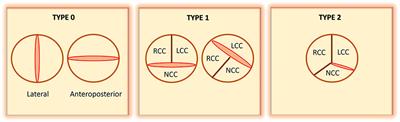 Clinical implications of the biomechanics of bicuspid aortic valve and bicuspid aortopathy